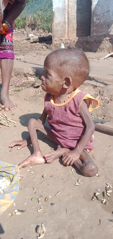 kutia child is suffering from malnutrition 