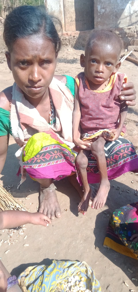A kutia child is suffering from malnutrition